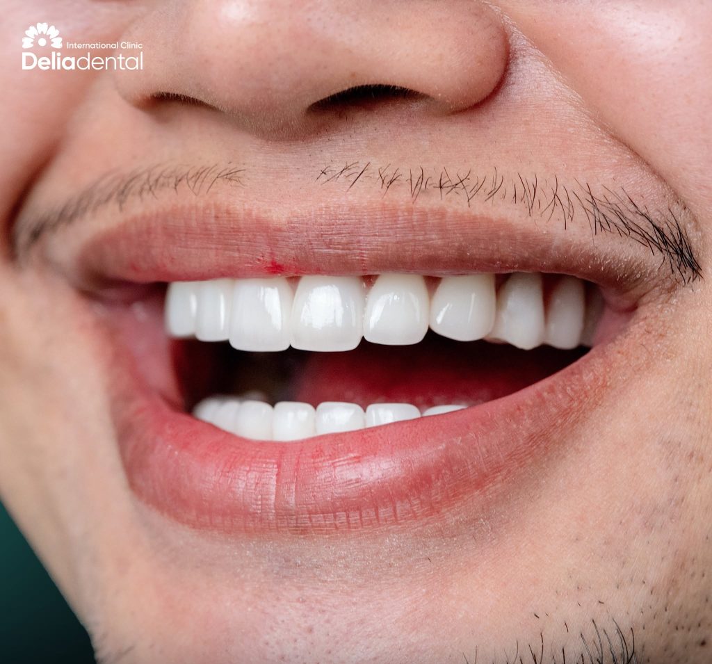 Emax Crown Procedure in Vietnam: Visits, Recovery & Aftercare