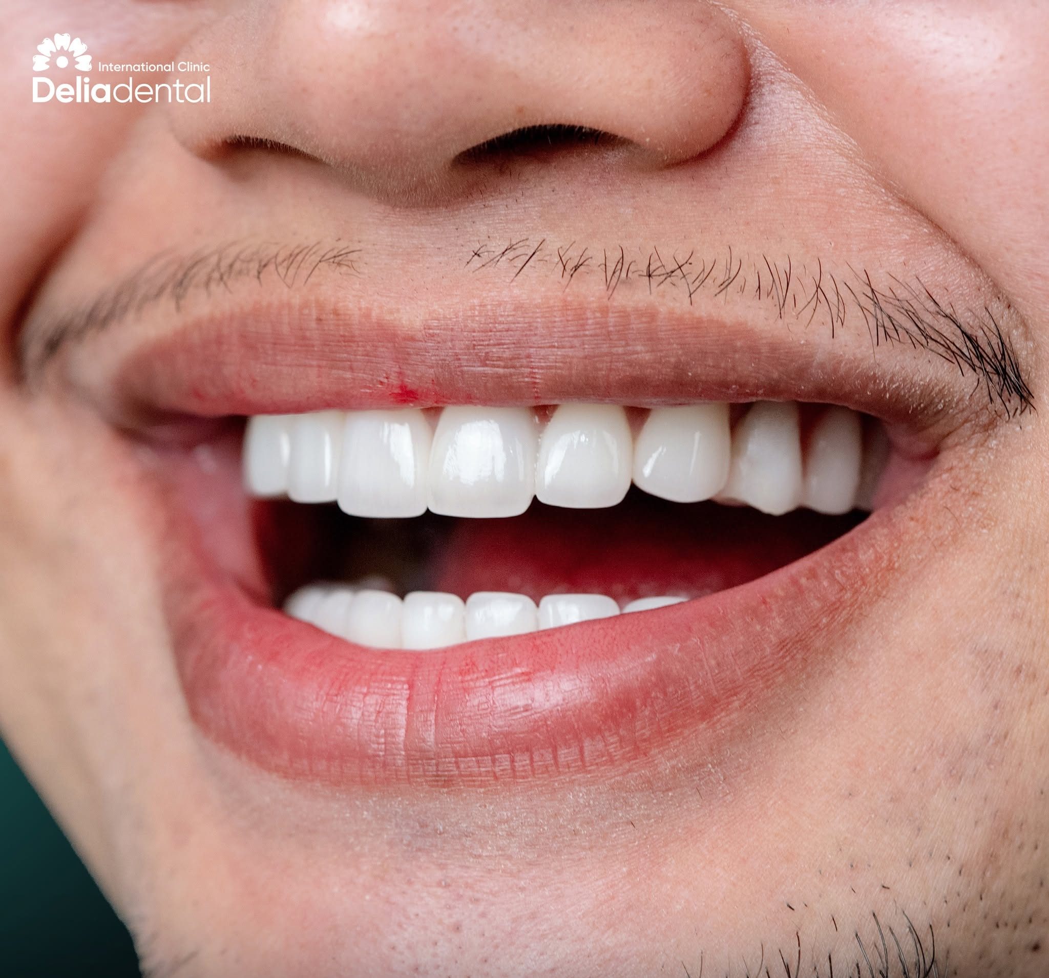 Emax Crown Procedure in Vietnam: Visits, Recovery & Aftercare