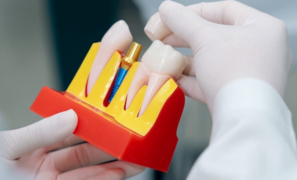 Full-Arch Vs Full-Mouth Dental Implants: Is One Jaw Or Both Treated?