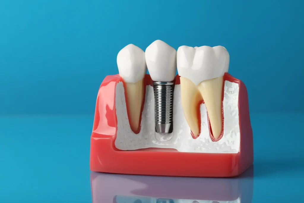 Implant Warranty vs Prosthetic Warranty: What Is Actually Covered?