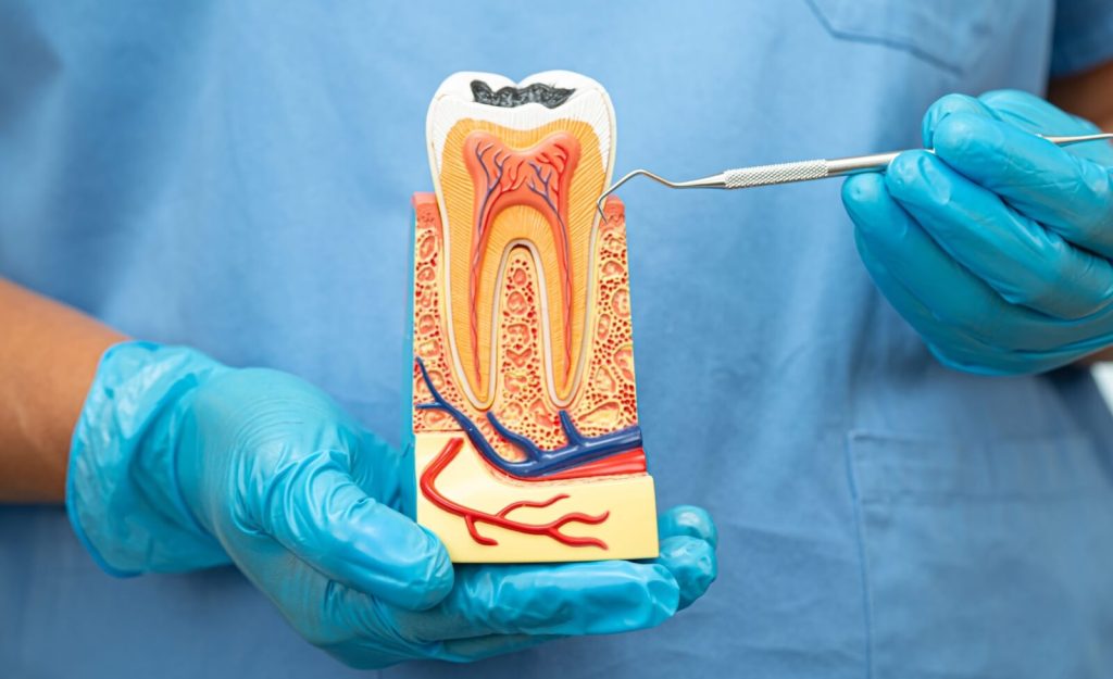 Do You Need a Root Canal Before a Crown in Vietnam?