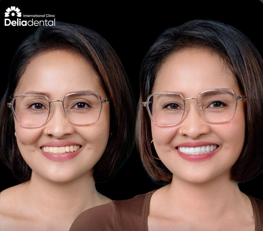 Smile Makeover in Vietnam: Cost, Timeline and Treatment Options