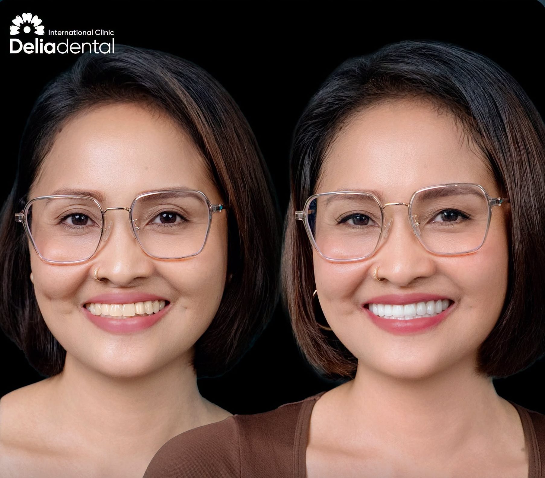 Smile Makeover in Vietnam: Cost, Timeline and Treatment Options