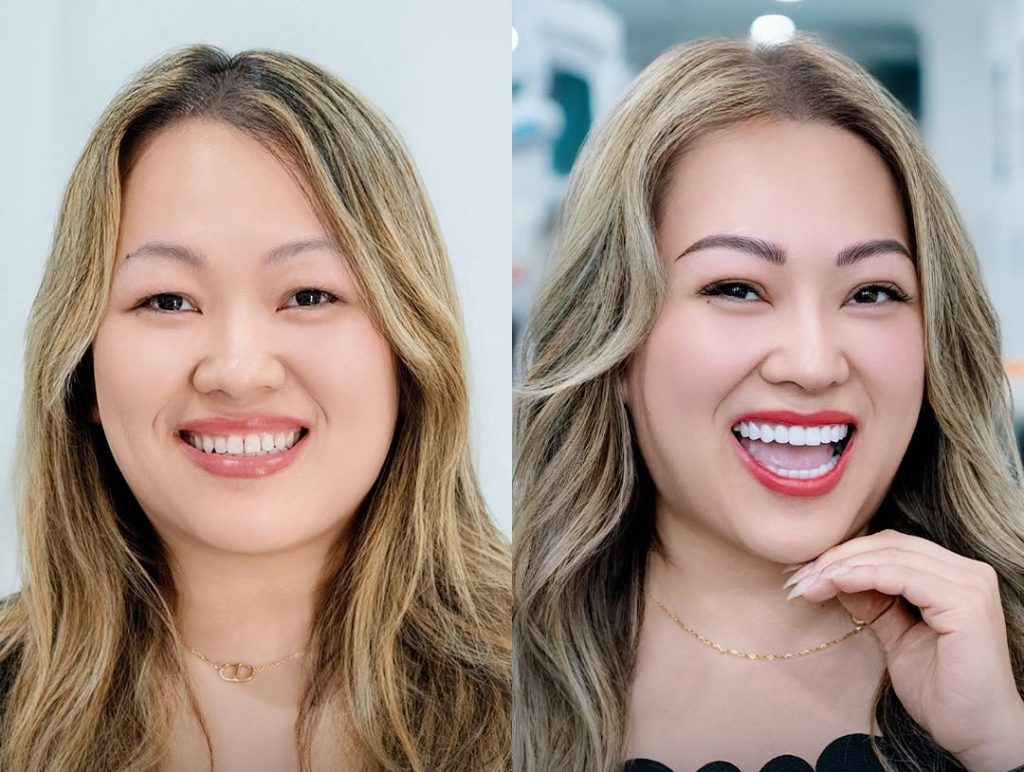 Porcelain Veneers in Vietnam: What to Expect from Consultation to Final Fit