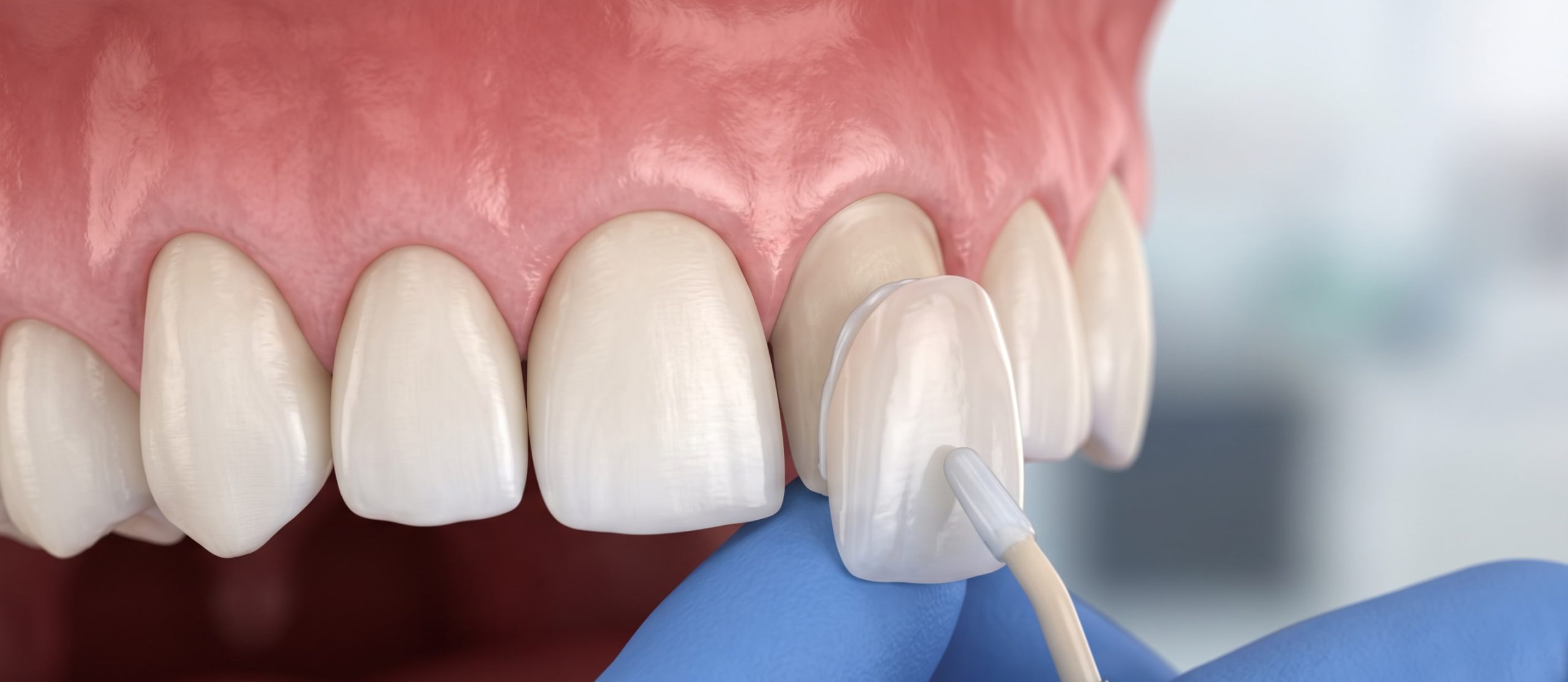 How Many Days Do Veneers in Vietnam Take?