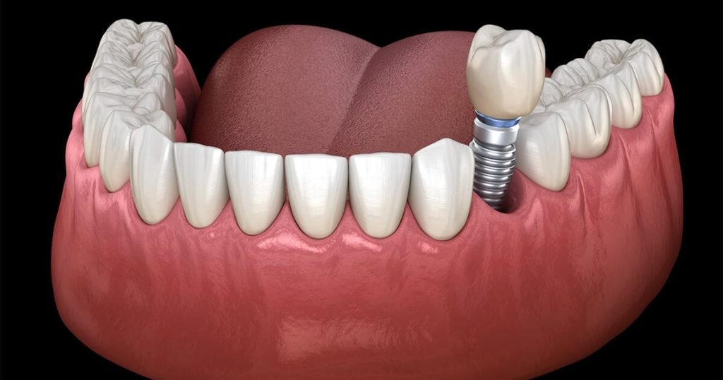 What If an Implant Crown Loosens After You Return Home?