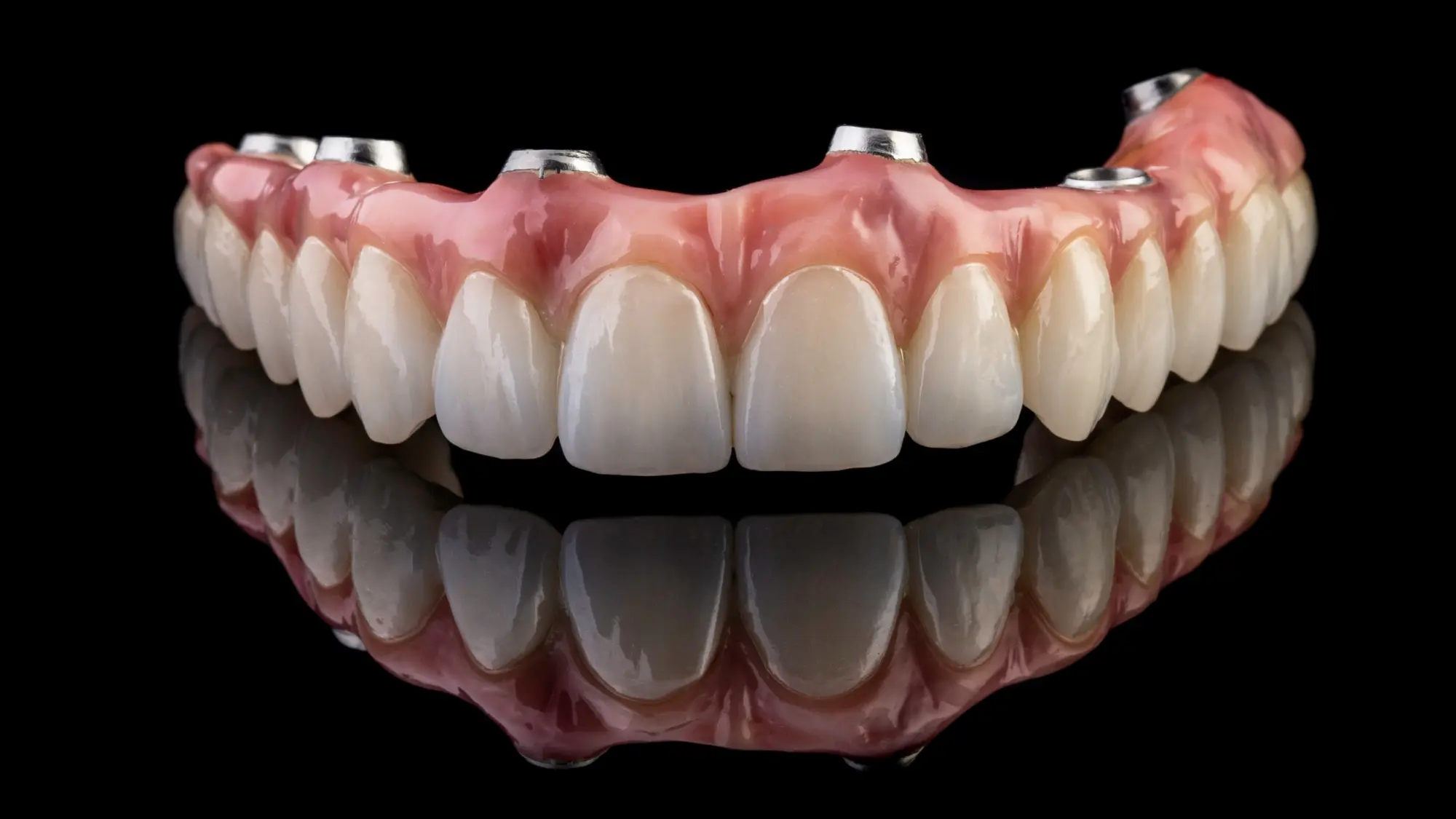 Should Every Failing Tooth Be Removed? When Full-Arch Implants Are the Right Choice