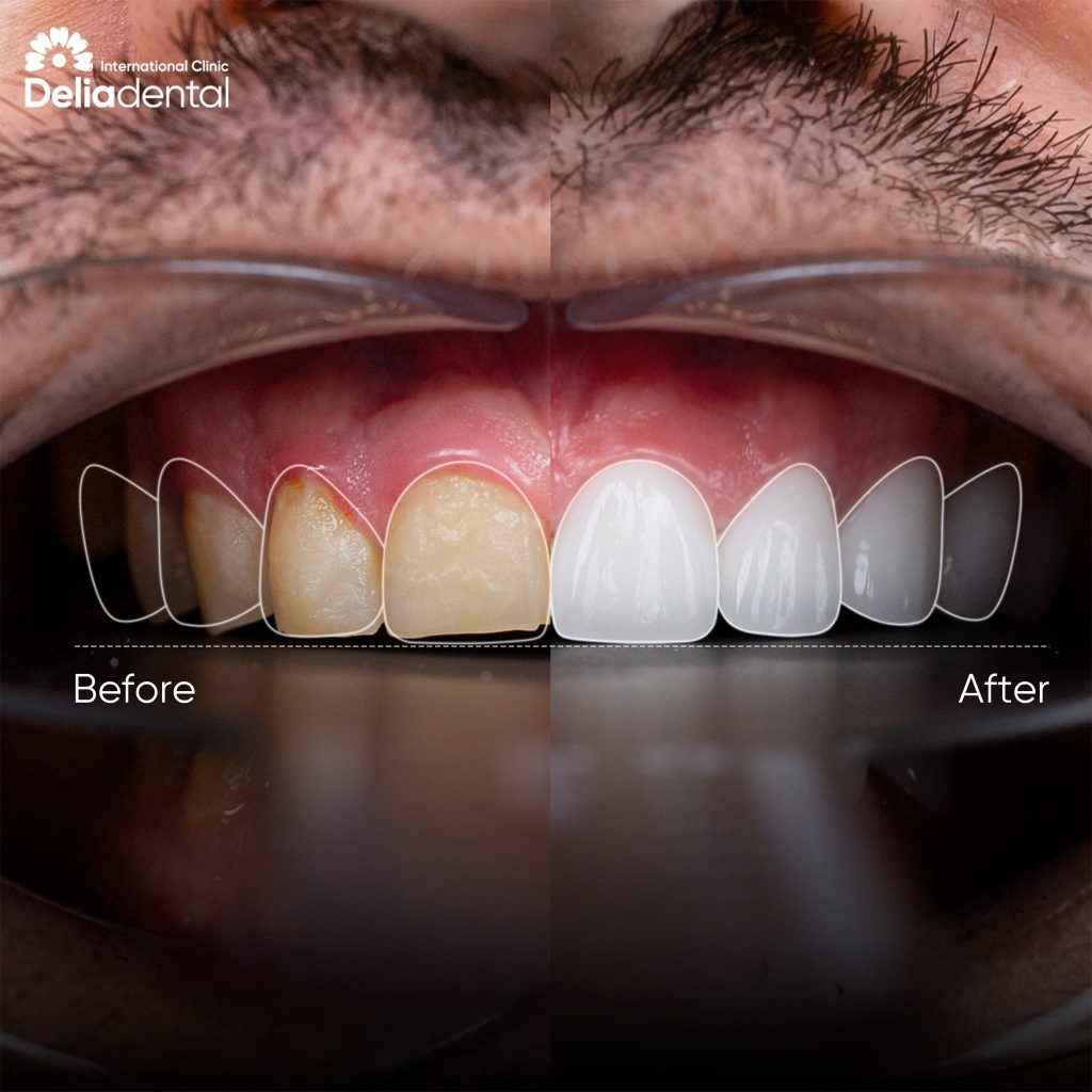 How to Check Zirconia Crown Quality in Vietnam Before Treatment