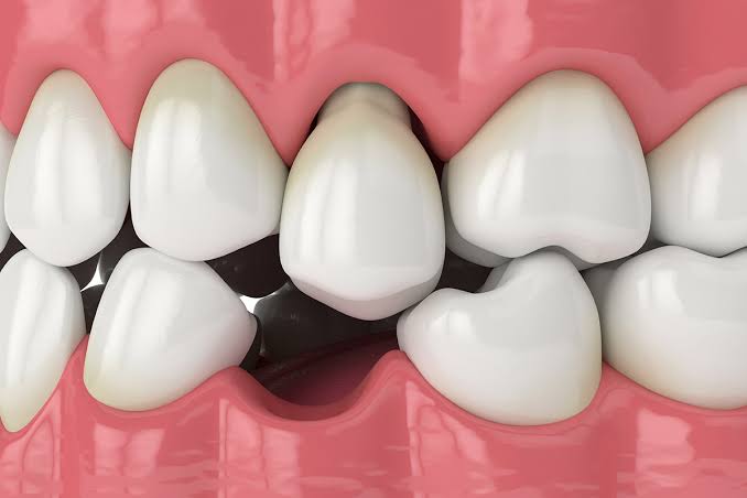 Missing Molar Tooth: What Waiting Actually Costs You