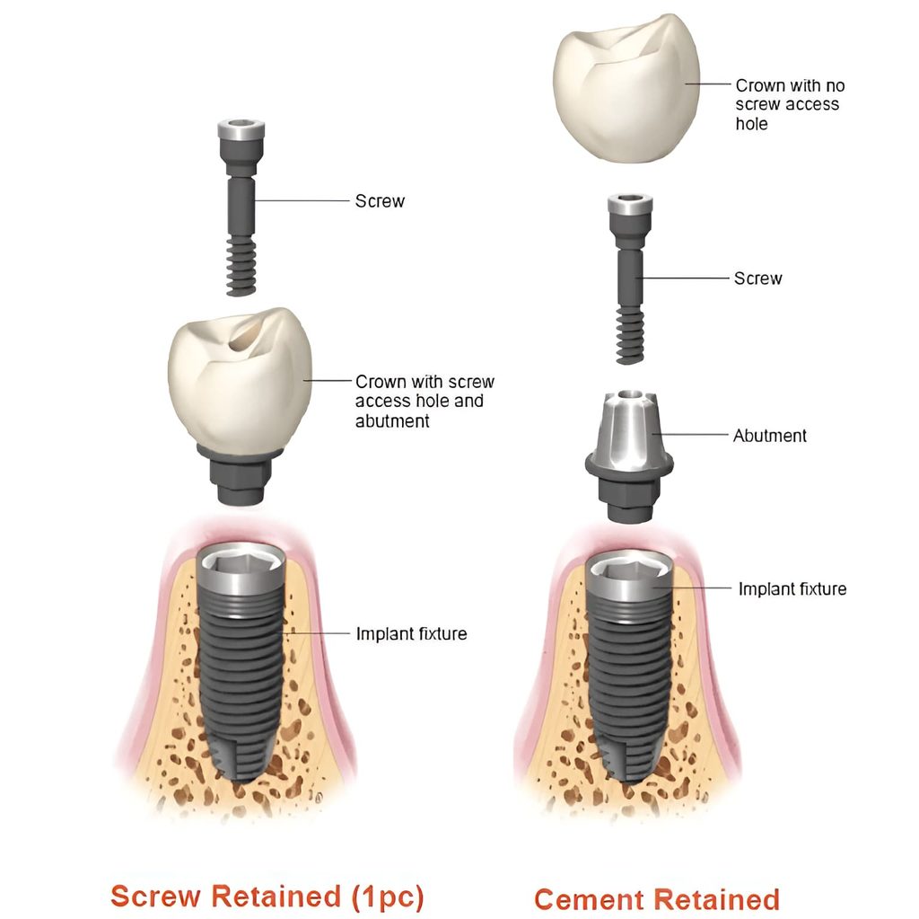 Implant Crowns 