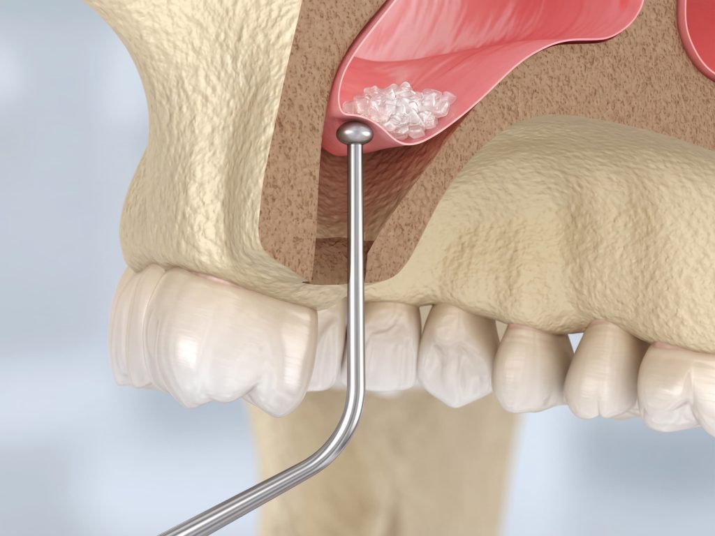Sinus Lift Before Dental Implants: When Is It Needed for Upper Jaw Implants?