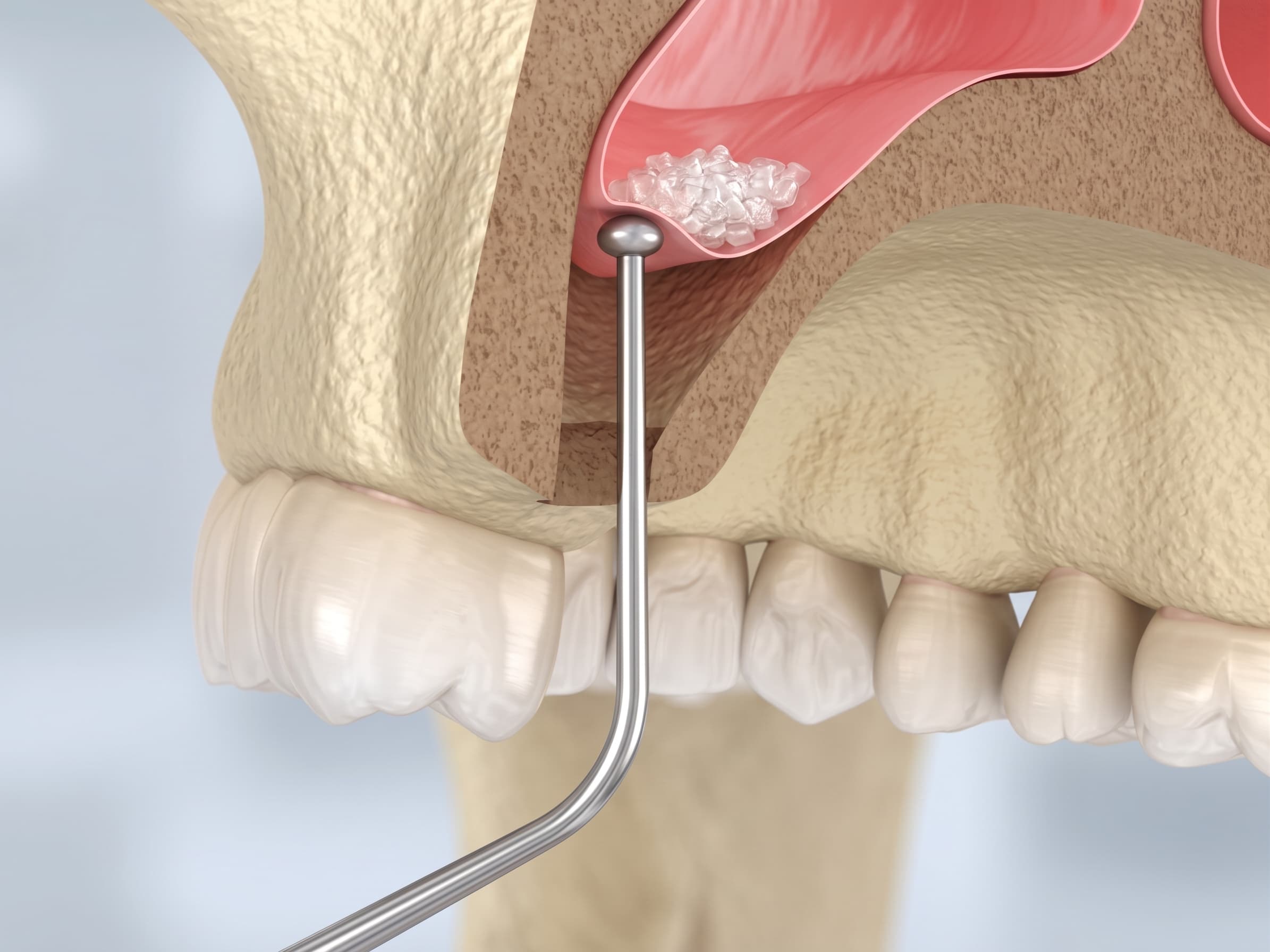Sinus Lift Before Dental Implants: When Is It Needed for Upper Jaw Implants?