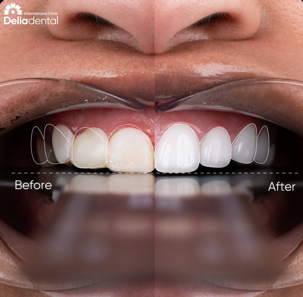Turkey Teeth Alternative: How Minimal-Prep Veneers in Vietnam Actually Work