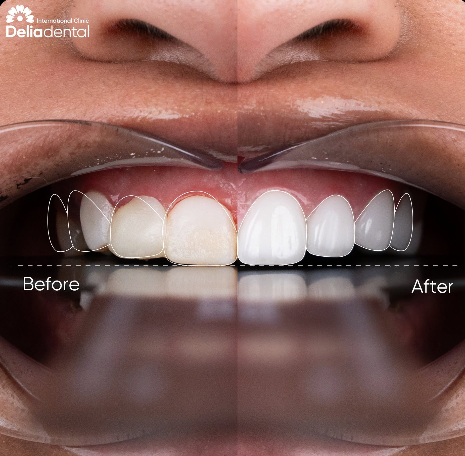 Turkey Teeth Alternative: How Minimal-Prep Veneers in Vietnam Actually Work