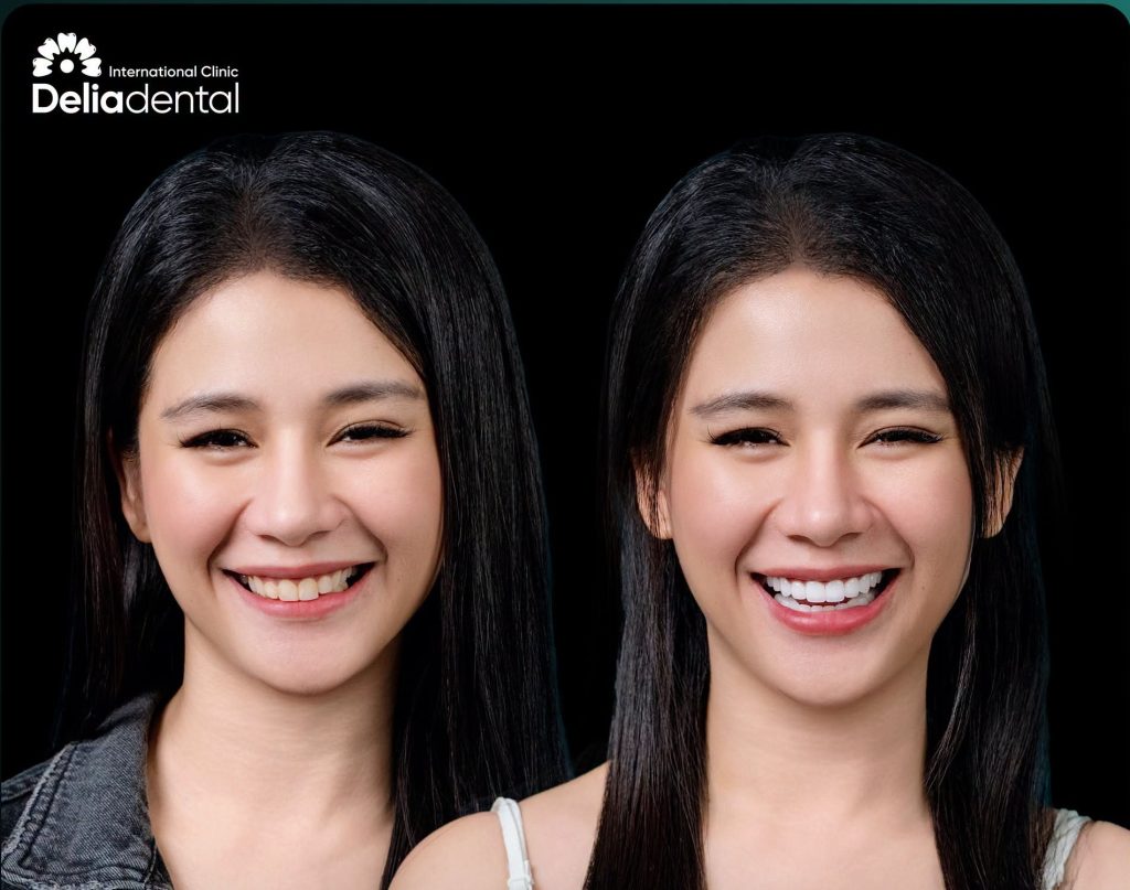 Why Delia Dental Clinic Vietnam is a Name Patients Trust for Dental Tourism