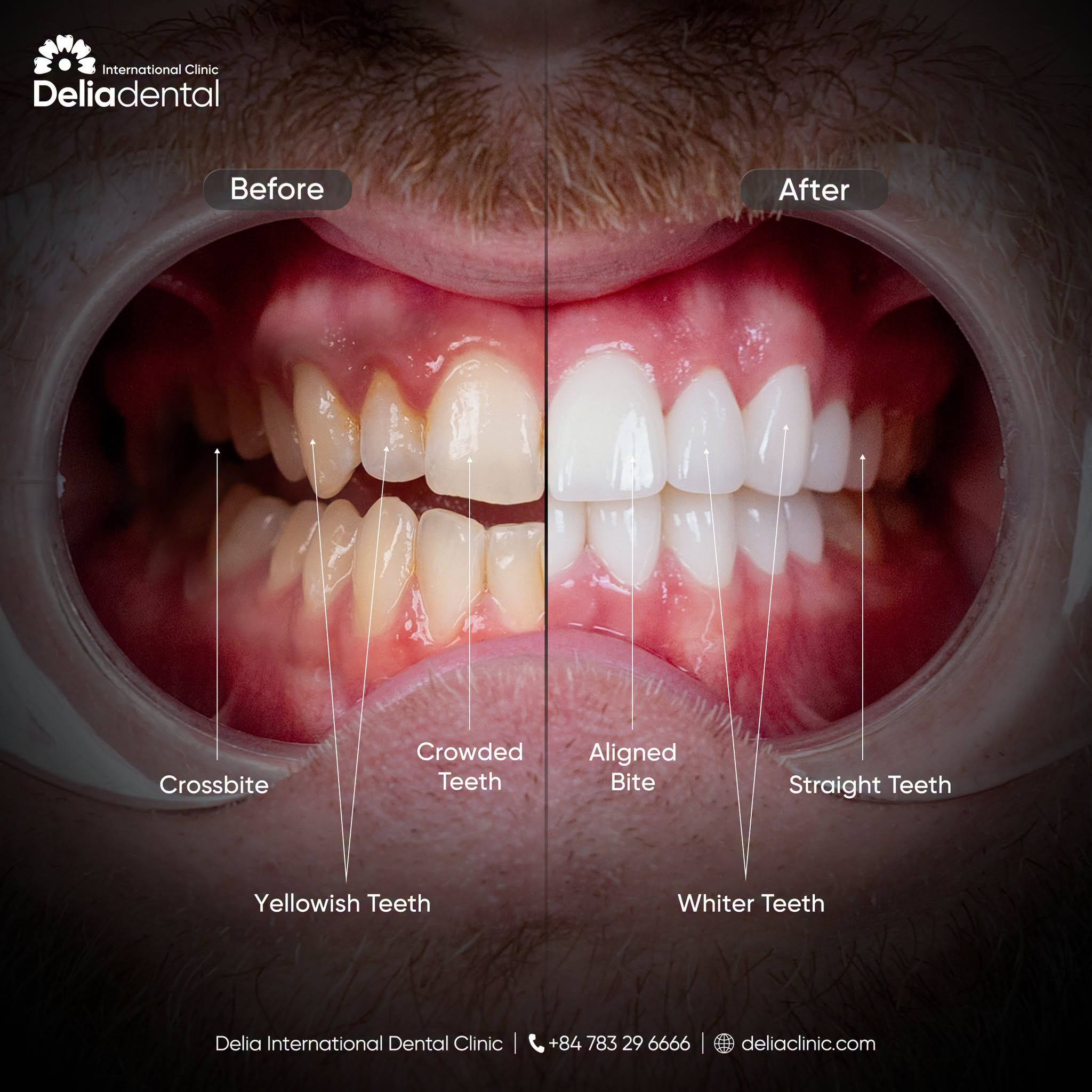 Before and after result at Delia Dental Clinic Vietnam