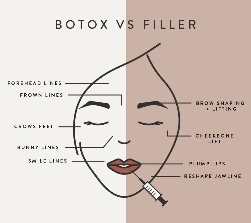 Botox vs filler