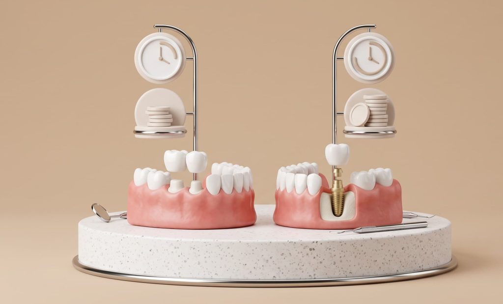 Bridge vs Implant: Which Lasts Longer and Costs Less