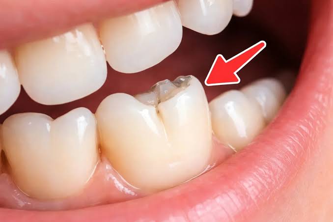 Chipped dental crown