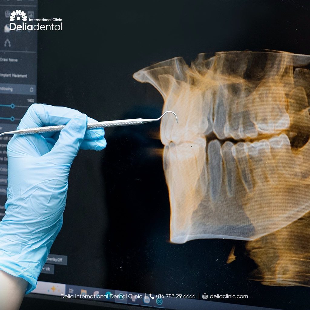 Is a CBCT Scan Required Before Every Dental Implant in Vietnam?