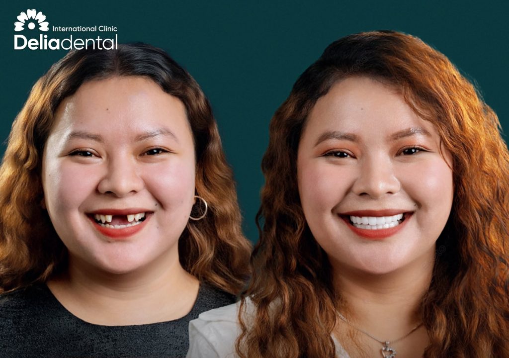 Front Tooth Implant: What to Expect From the Temporary Tooth and the Final Result