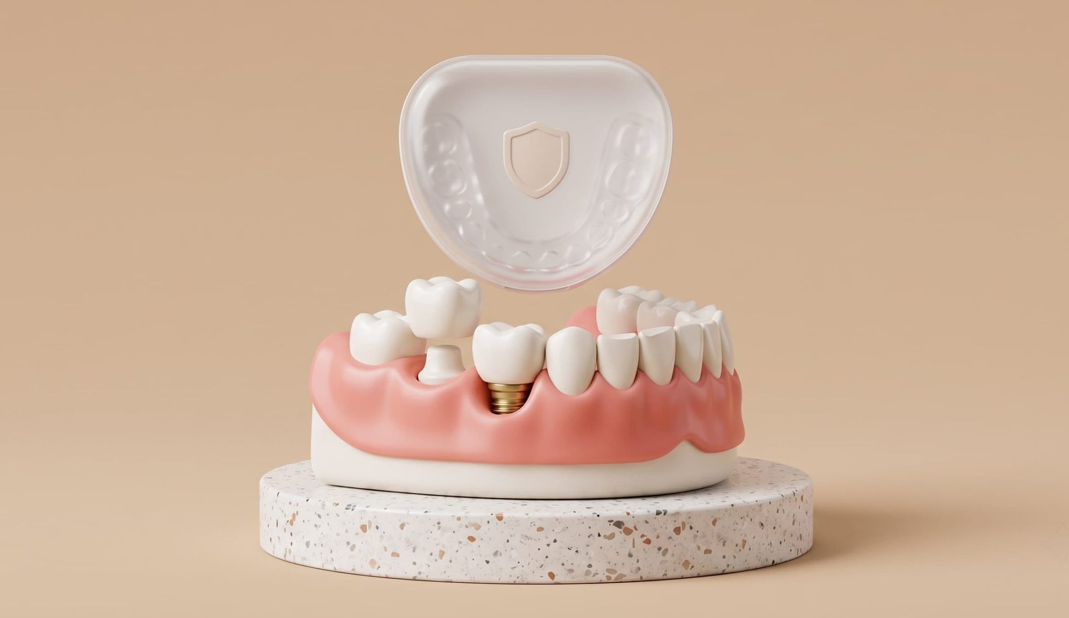 Night Guard After Implants or Crowns: Do You Actually Need One?