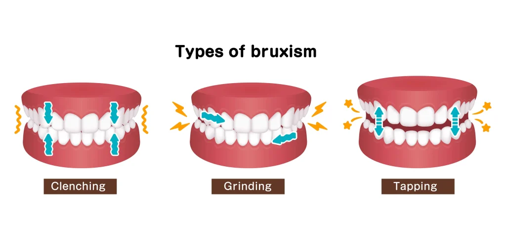 Types of Bruxism