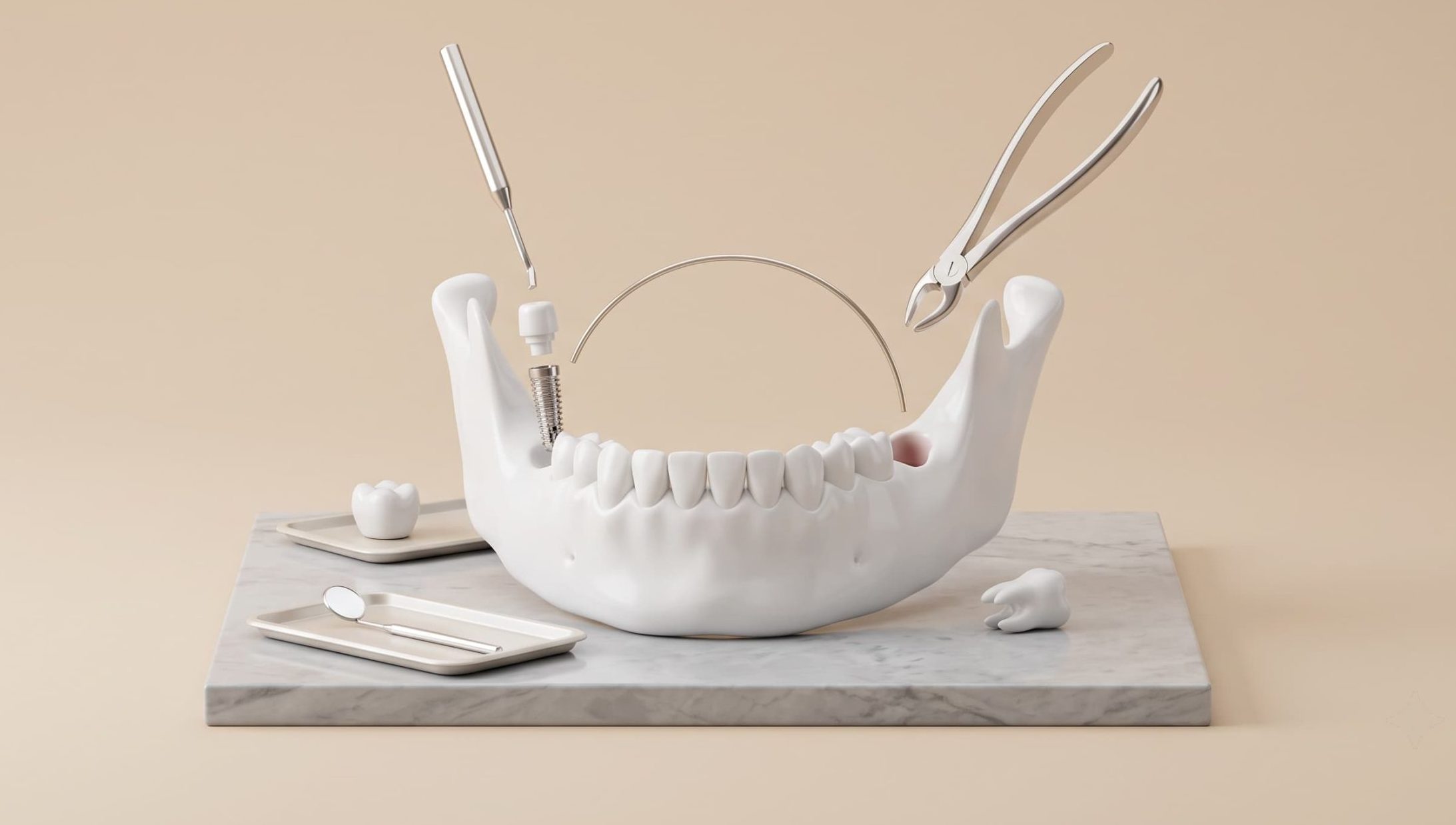 Wisdom Tooth Removal Before Dental Implants: When You Need It