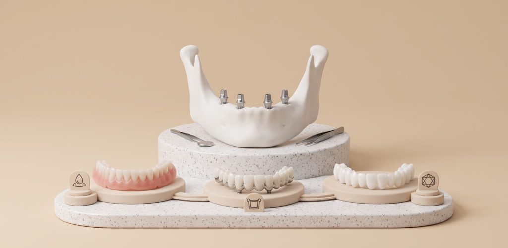 All-on-4 Final Teeth: Acrylic, Metal Ceramic or Zirconia?