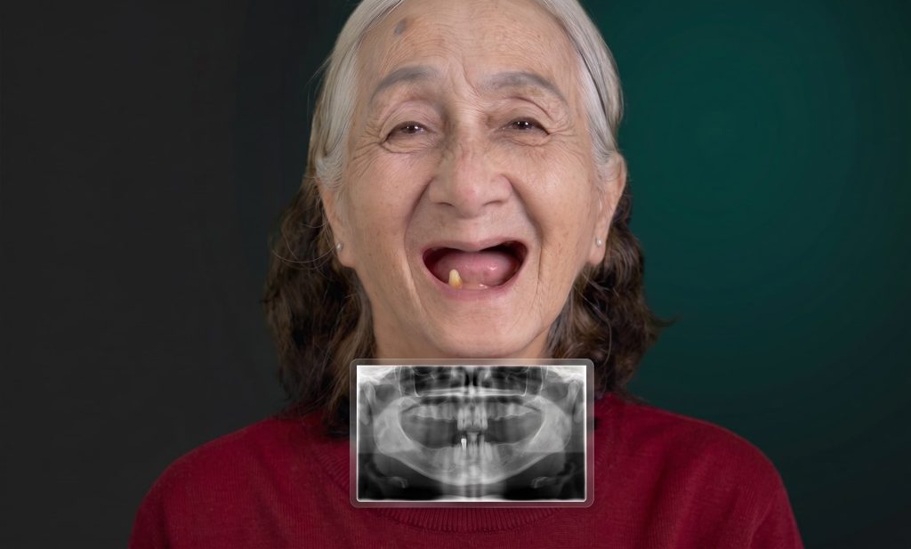 Dental Implants After Years of Missing Teeth: Is It Too Late?