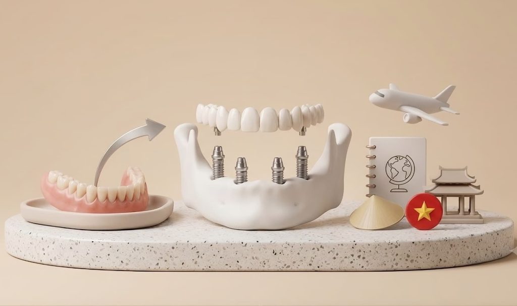 Switching From Dentures to Fixed Implants in Vietnam
