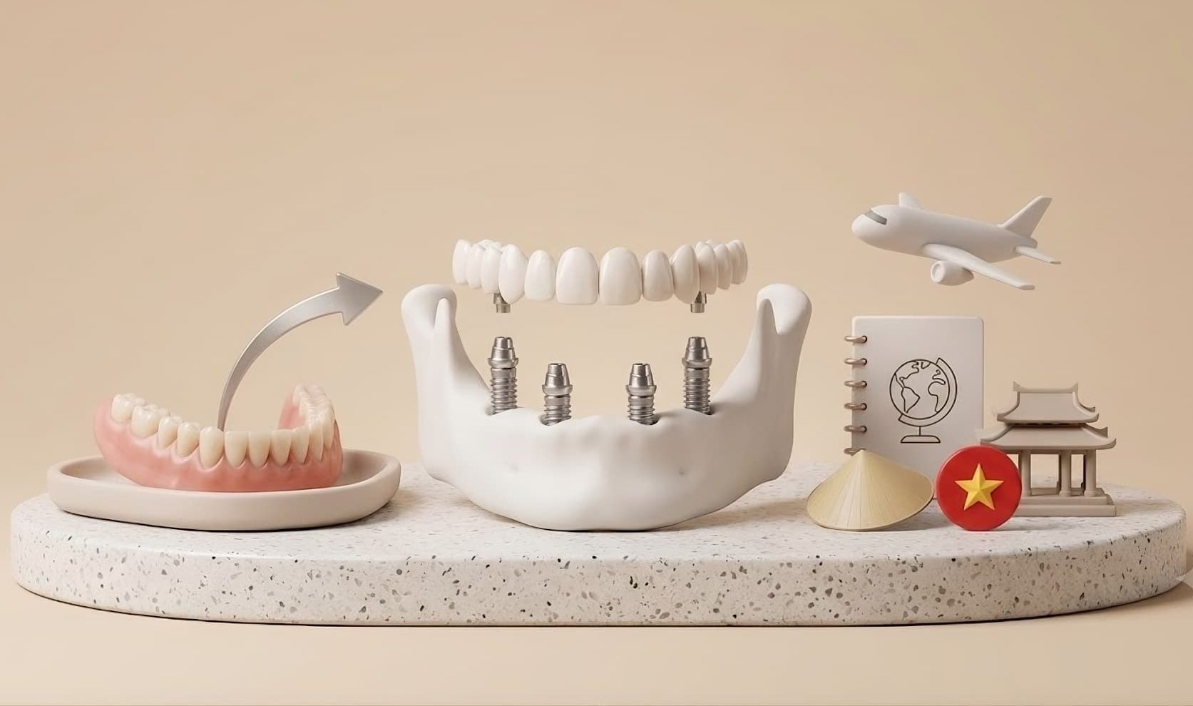 Switching From Dentures to Fixed Implants in Vietnam